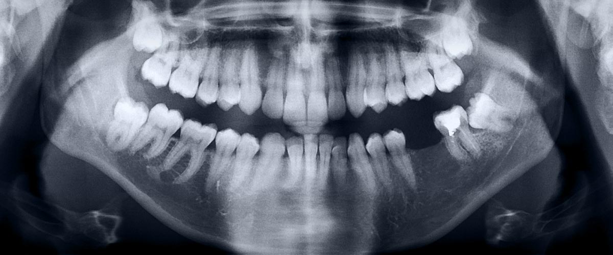 Panorama-røntgenbillede af mistet tand før en tandimplantat operation